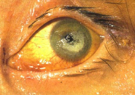 Beratitis keratitis הנגרמת על ידי קנדידה אצל ילד עם חוסר חיסונים חמור