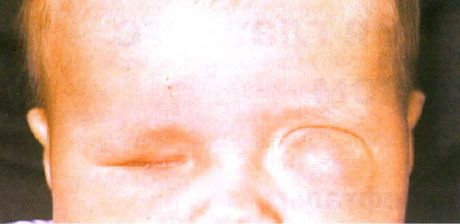 Microphthalmus עם היווצרות ציסטה במקביל (עין שמאל).  אנופתלמוס (עין ימין).