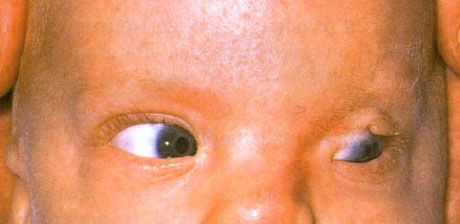 תסמונת פרייזר.  קריפטופתלמוס שלם של העין השמאלית.