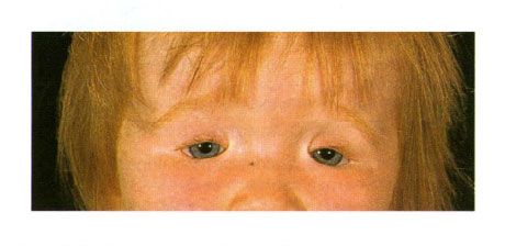 קולובומה דו צדדית של העפעפיים אצל ילד עם תסמונת גולדן.  סדק העין סדק משמאל
